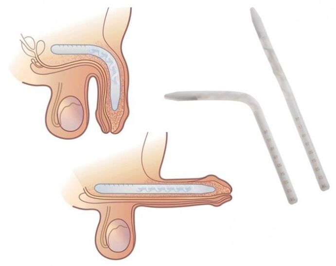 Falloplastia kidea handitzeko