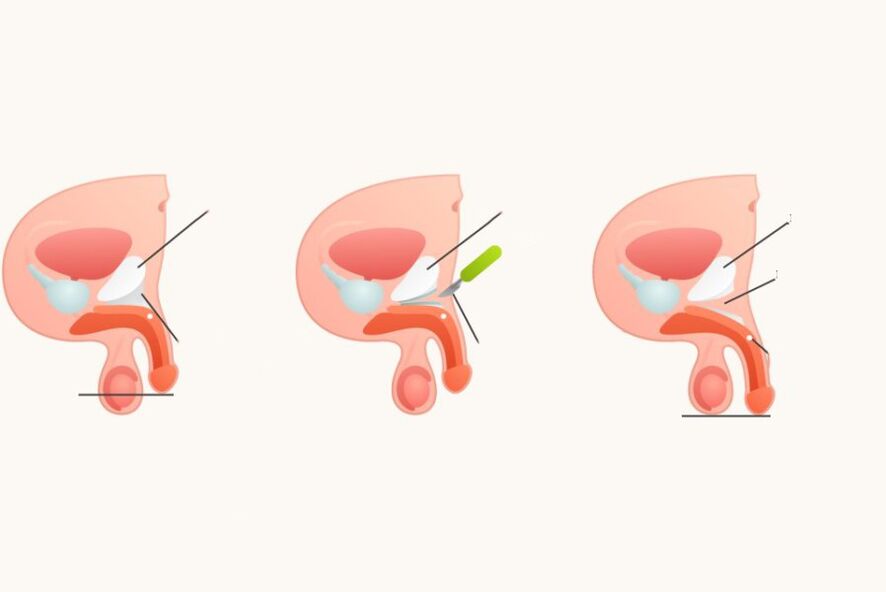Ligamentotomia zakila handitzeko