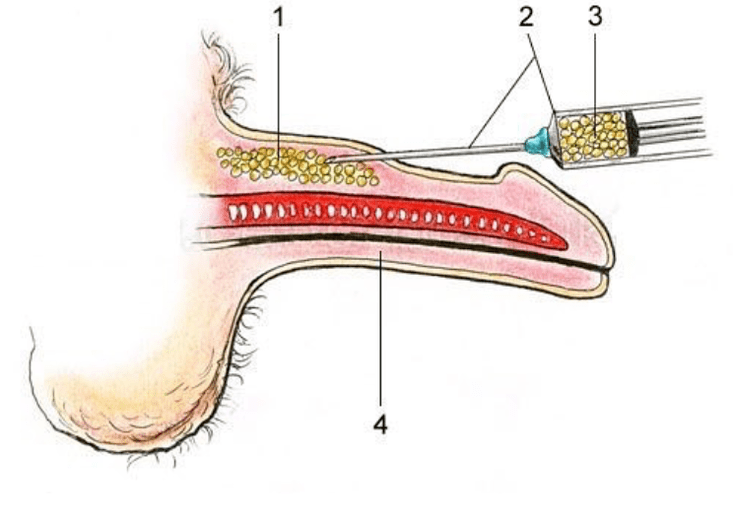 lipofilia kidea handitzeko