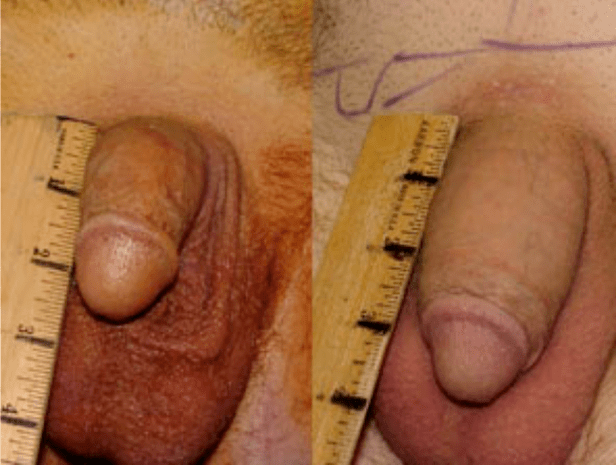 Lipofilling eta gel inplantatu aurretik eta ondoren